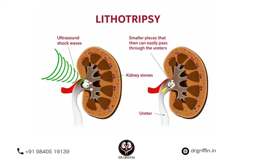 Kidney Stone Removal