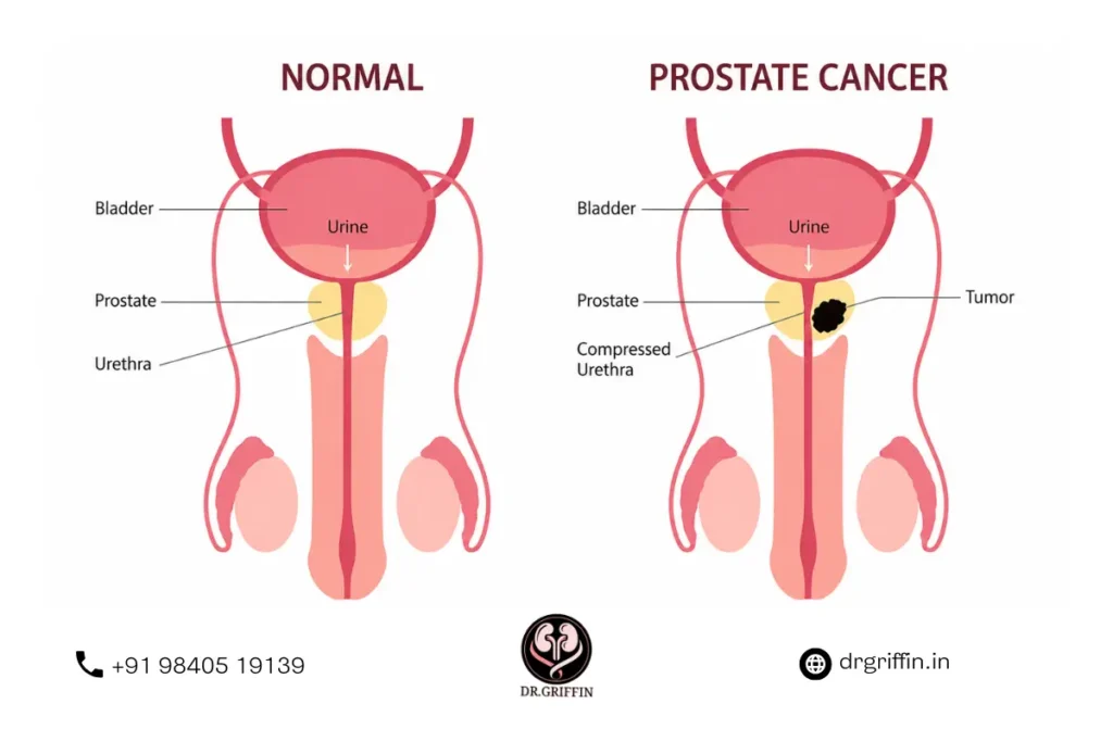Stage 4 Prostate Cancer