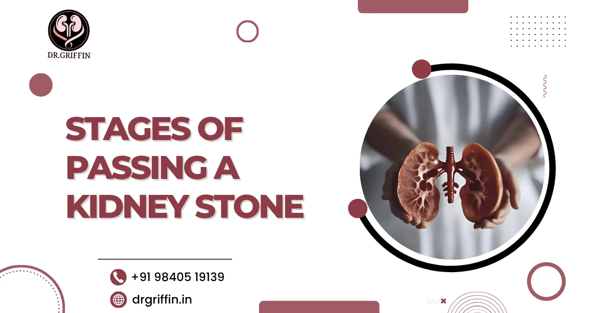 Stages of passing a kidney stone