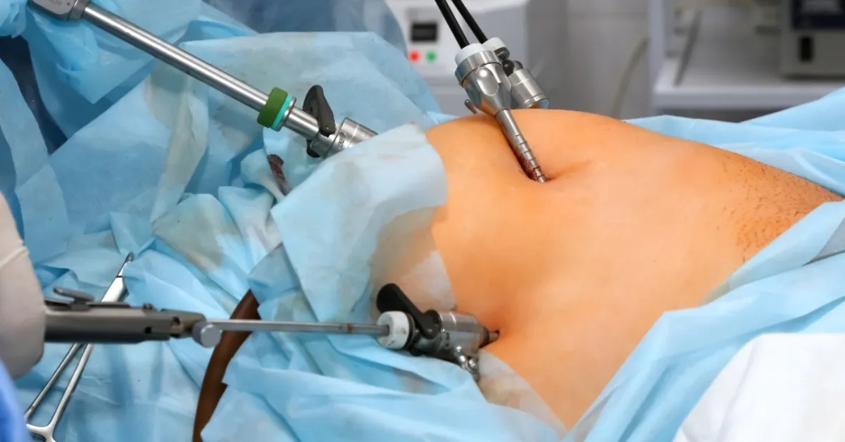 Micro-Varicocele Surgery