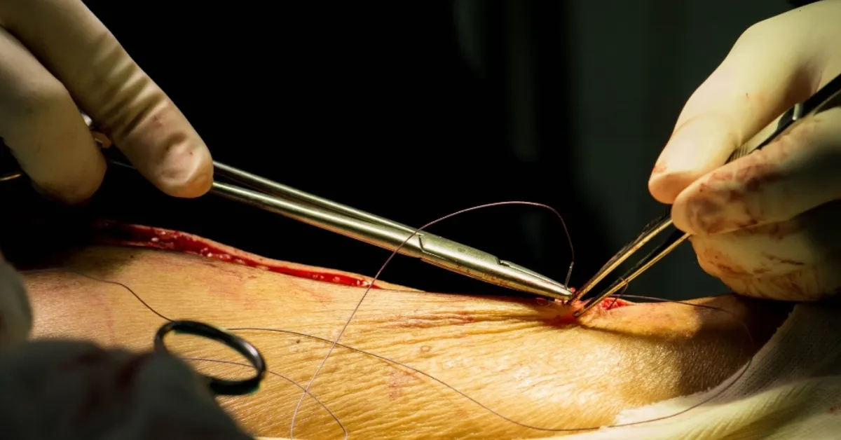 Pyeloplasty