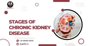 Stages of Chronic Kidney Disease