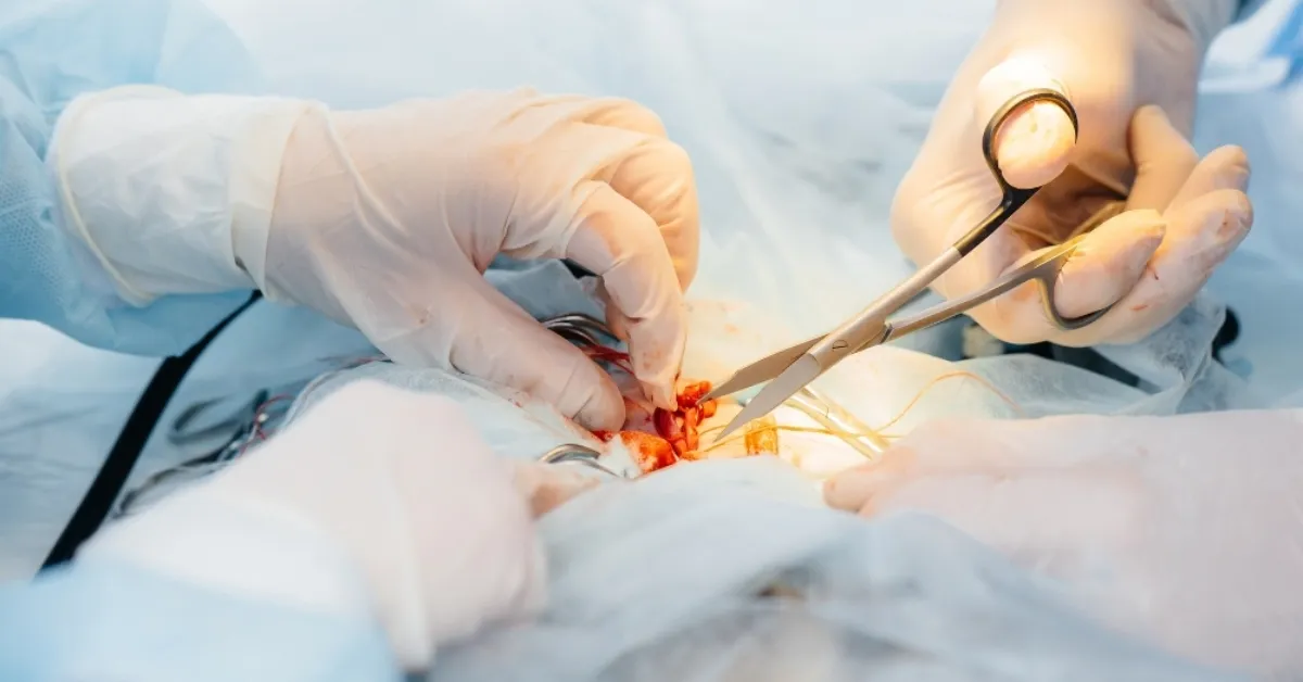 Varicocele Repair