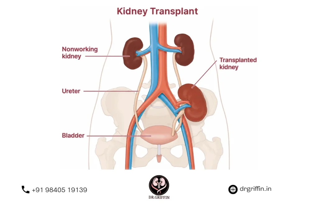 Best Kidney Transplant Surgeon in Chennai
