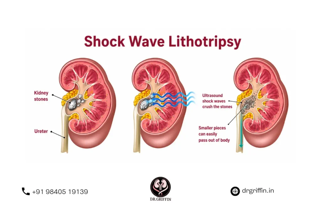 Kidney Stone Surgeon in ECR