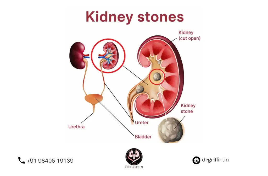Kidney Stone Specialist in India